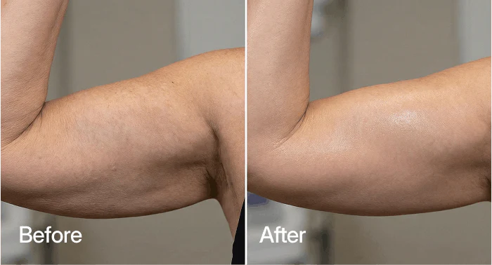 Michelle R. before and after results
